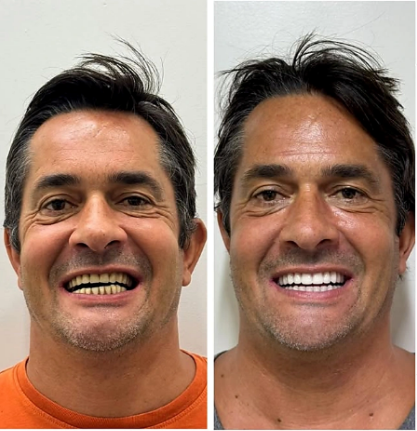 Antes e depois de caso real de prótese protocolo