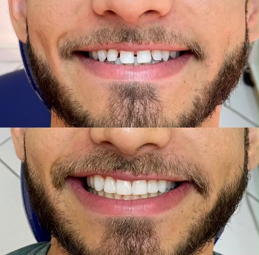 Antes e depois de caso real de estética odontológica